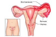 Двухстороннее воспаление яичников 9