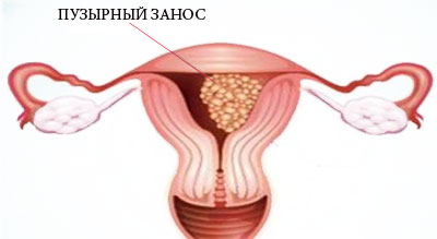 Деформация плодного яйца