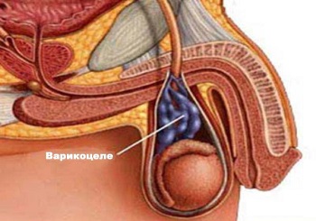 Общая статистика и симптомы варикоцеле