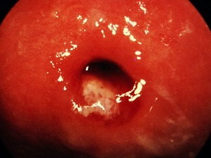 Воспаление цервикального канала