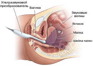 Диагностика гиперплазии эндометрия