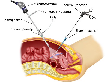 Признаки ретенционного образования левого яичника 22