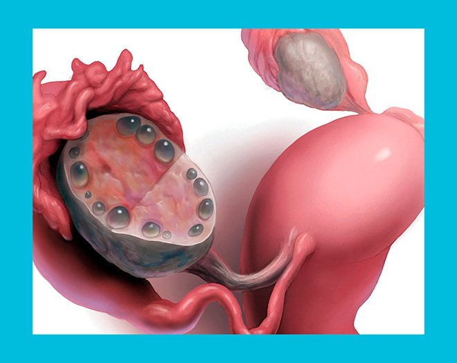 multifollicular ovaries1.jpg