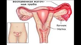 Аднексит может привести к бесплодию