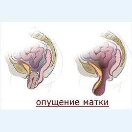 Выпадение влагалища – лечение патологии