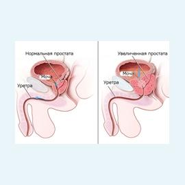 Гиперплазия предстательной железы
