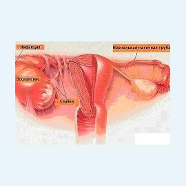 Воспаление матки и беременность
