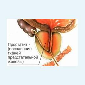 Простатит и его лечение