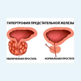 Гипертрофия простаты