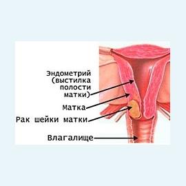 Рак шейки матки 