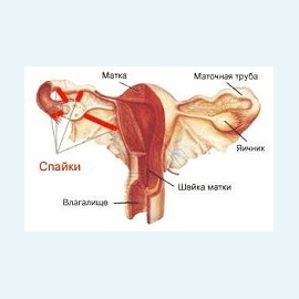 Спайки