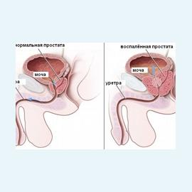 Хронический простатит