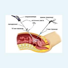 Лапароскопия