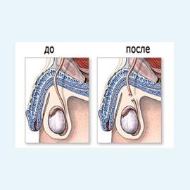 Вазэктомия мужская и женская
