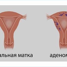 Аденомиоз и успешность ЭКО