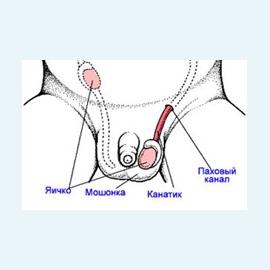 Крипторхизм истинный и ложный
