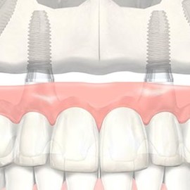 Верните зубы за 1 день по технологии Аll-on-4