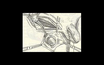 Крипторхизм - причины, диагностика, лечение и последствия