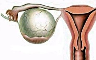 Чем опасно жидкостное образование в яичнике