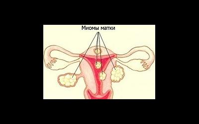 Размеры матки при миоме