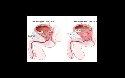 Гиперплазия предстательной железы