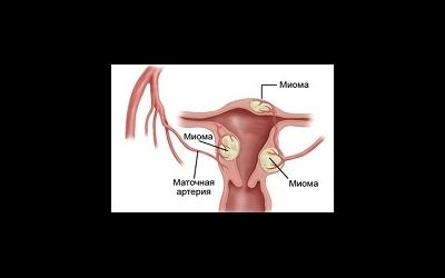 Миома матки: причины, классификация, клиника, методы традиционного и нетрадиционного лечения