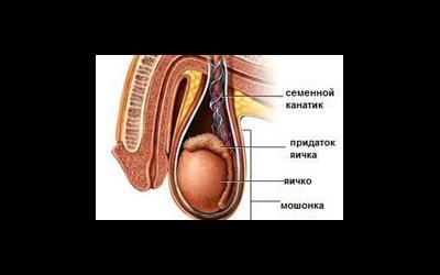 Отсутствие семявыводящего протока