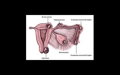 Что скрывается за диагнозом «внематочная беременность»