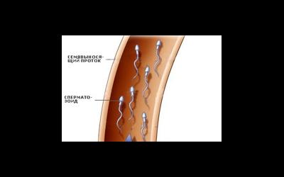 Атрезия семявыносящего протока