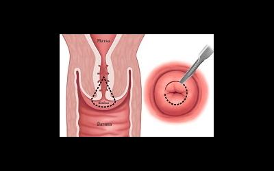 Биопсия в гинекологии