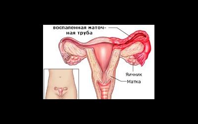 Сальпингит хронический двусторонний сальпингит