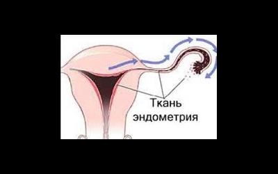 Хронический эндометрит и его основные признаки Хронический эндометрит и его основные признаки