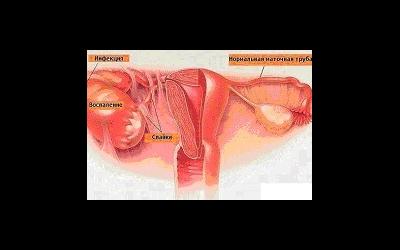 Воспаление матки и беременность