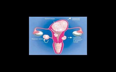 Что нужно знать про миому матки