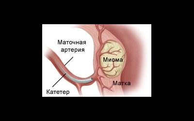 Современные методы лечения миомы матки