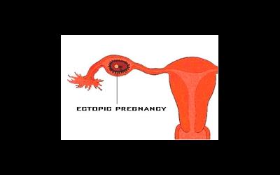О признаках внематочной беременности