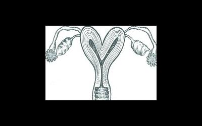Маточный фактор бесплодия - двурогая и седловидная матка