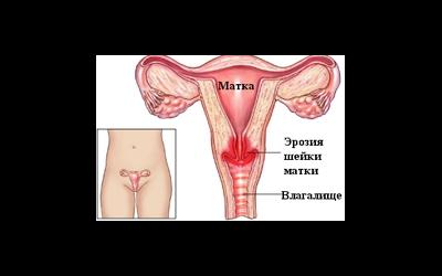 Эрозия шейки матки Эрозия шейки матки