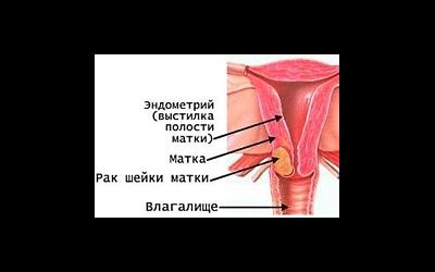 Рак шейки матки Рак шейки матки