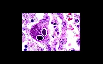 Цитомагеловирус – еще одна причина мужского бесплодия