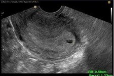 Плодное яйцо в углу матки: особенности прикрепления эмбриона