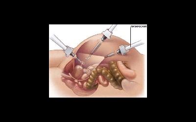 Операция по удалению миомы матки