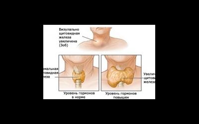 Базедова болезнь, или болезнь Грейвса