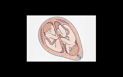 Что надо знать о многоплодной беременности