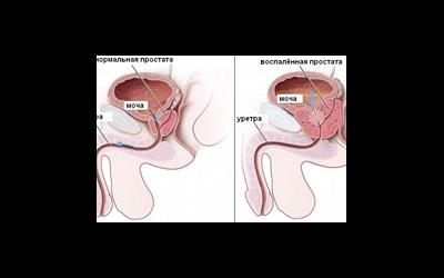 Хронический простатит