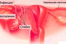 Непроходимость маточных труб