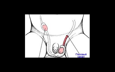 Неопущение яичек (крипторхизм)