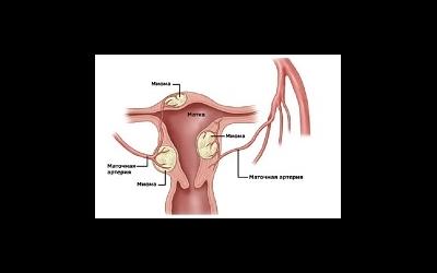 Субсерозная миома матки: симптомы и лечение