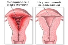 Гиперплазия эндометрия