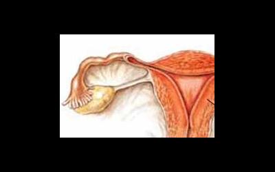 Непроходимость маточных труб как причина бесплодия
